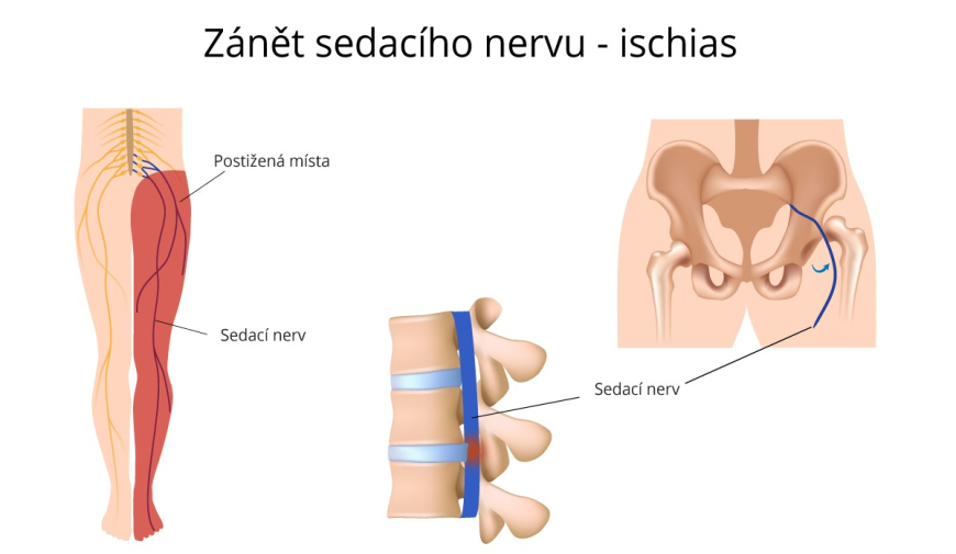 rady, tipy, zdraví, sedací nerv, jak si pomoct